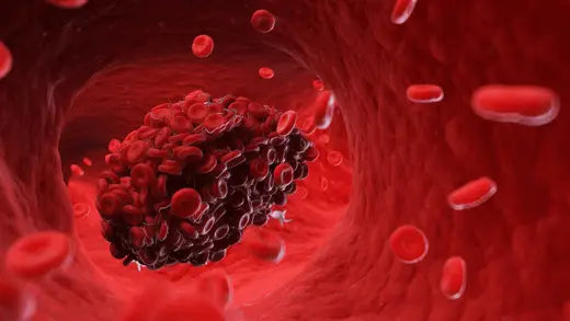 Blood clot in a vessel featured in an article about can a massage gun cause blood clots