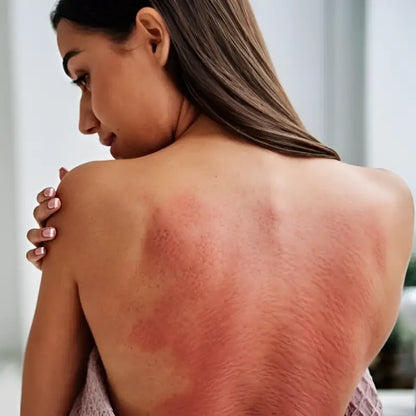 Sunburnt woman’s back relieved by black acupressure mat Akumata