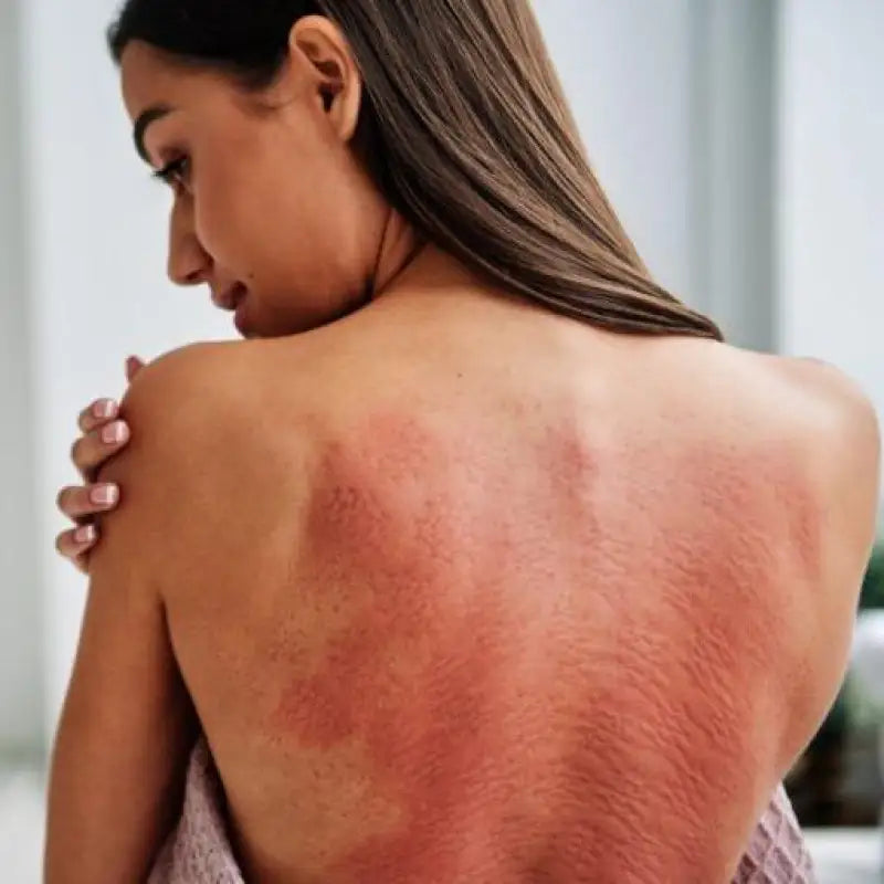 Woman’s back with irritated skin using Brown Acupressure Mat | Akumata ECO