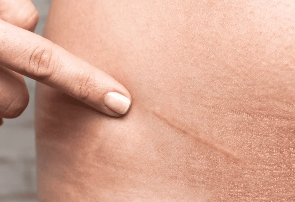 Avantages de l'utilisation d'un Massage Gun pour décomposer les tissus cicatriciels