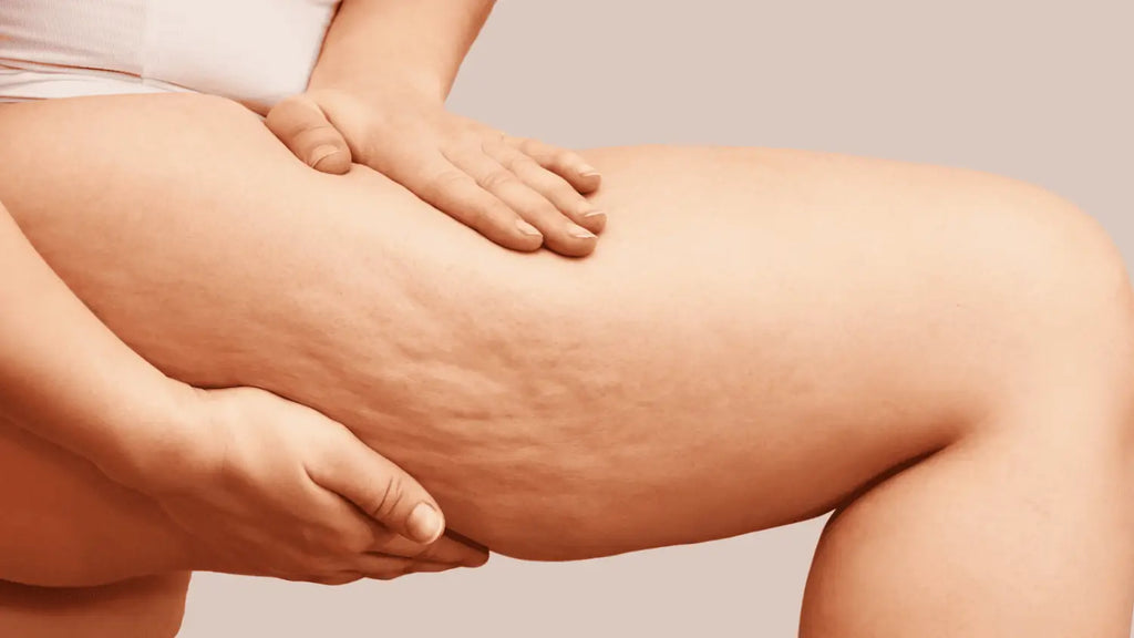 Comprendre la cellulite : ce que c'est et comment elle se forme